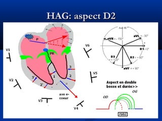 HAG: aspect D2HAG: aspect D2
 