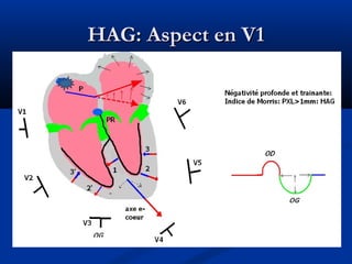 HAG: Aspect en V1HAG: Aspect en V1
 