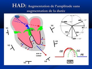 HAD:HAD: Augmentation de l’amplitude sansAugmentation de l’amplitude sans
augmentation de la duréeaugmentation de la durée
 