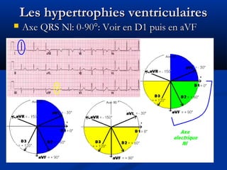 Les hypertrophies ventriculairesLes hypertrophies ventriculaires
 Axe QRS Nl: 0-90°: Voir en D1 puis en aVFAxe QRS Nl: 0-90°: Voir en D1 puis en aVF
 