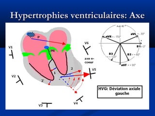Hypertrophies ventriculaires: AxeHypertrophies ventriculaires: Axe
 