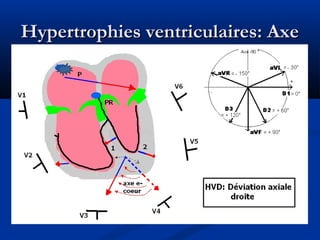 Hypertrophies ventriculaires: AxeHypertrophies ventriculaires: Axe
 