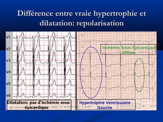 Différence entre vraie hypertrophie etDifférence entre vraie hypertrophie et
dilatation: repolarisationdilatation: repolarisation
 