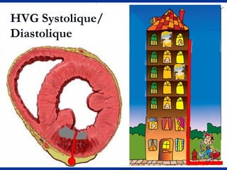 HVG Systolique/
Diastolique
 