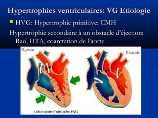 Hypertrophies ventriculaires: VG EtiologieHypertrophies ventriculaires: VG Etiologie
 HVG: Hypertrophie primitive: CMHHVG: Hypertrophie primitive: CMH
Hypertrophie secondaire à un obstacle d’éjection:Hypertrophie secondaire à un obstacle d’éjection:
Rao, HTA, coarctation de l’aorteRao, HTA, coarctation de l’aorte
 