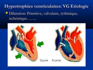 Hypertrophies ventriculaires: VG EtiologieHypertrophies ventriculaires: VG Etiologie
 Dilatation: Primitive, valvulaire, rythmique,Dilatation: Primitive, valvulaire, rythmique,
ischémique…….ischémique…….
 