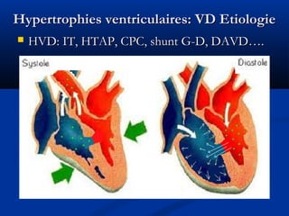 Hypertrophies ventriculaires: VD EtiologieHypertrophies ventriculaires: VD Etiologie
 HVD: IT, HTAP, CPC, shunt G-D, DAVD….HVD: IT, HTAP, CPC, shunt G-D, DAVD….
 