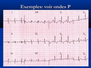 Exemples: voir ondes PExemples: voir ondes P
 