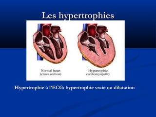 Les hypertrophiesLes hypertrophies
Hypertrophie à l’ECG: hypertrophie vraie ou dilatation
 
