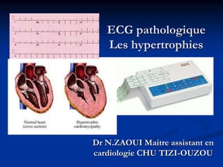 ECG pathologique
Les hypertrophies
Dr N.ZAOUI Maitre assistant en
cardiologie CHU TIZI-OUZOU
 