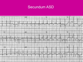 Ecg pediatric | PPTX