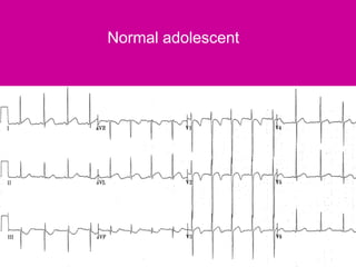 Ecg pediatric | PPTX