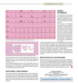 P É D A G O G I E D E L’ E C G

CRITÈRES
DE NORMALITÉ

Tracé ECG 12 dérivations, avec en-dessous enregistrement continu de V1, D2 et V5.

Ils existent pour les dérivations
des membres et pour les dérivations précordiales. Durée, amplitude, morphologie, territoire
concerné seront successivement
analysés.
Cette analyse est cependant
étroitement liée aux conditions
techniques d’enregistrement.
L’étalonnage de l’appareil doit
être tel qu’un test de 1 millivolt
provoquer un signal rectangulaire de 1 cm de haut. La vitesse
de déroulement est habituellement de 25 mm/seconde, chaque millimètre correspond alors
à 0,04 seconde, 5 millimètres à
0,20 secondes et 25 millimètres
à 1 seconde.
La ligne isoélectrique doit dans la mesure du possible être horizontale
et nette, exempte de parasites, et les câbles doivent être branchés
dans le bon ordre. De multiples moyens mnémotechniques existent
pour cela, le plus simple étant « la Route Nationale traverse la Prairie
Ensoleillée » où il suffit de savoir que R = Rouge et Right.
Le tracé doit comporter au minimum les 12 dérivations principales,
dans l’ordre : DI, DII, DIII – dérivations bipolaires -, puis aVR, aVL, aVF
- dérivations unipolaires des membres -, puis les six précordiales de
V1 à V6.

L’ axe horizontal représente les unités de temps et l’axe vertical l’amplitude du voltage.

positive est nommée r ou R. Une onde négative est nommée q ou Q si
elle précède r ou R, s ou S si elle suit r ou R. Toute onde entièrement
négative est dénommée qs ou QS. Toute seconde onde positive est
nommée r’ ou R’.
Une remarque importante concerne aVR : aVR regarde la cavité cardiaque par sa face endocardique, et la dépolarisation se fait de l’endo
vers l’épicarde, en conséquence de quoi aVR est toujours négatif, et
un aspect QS peut être normal en aVR.

TRACÉ NORMAL / TRACÉS NORMAUX
Deux obstacles majeurs se potentialisent devant un tracé à interpréter :
d’une part, il existe une grande variété d’images électrocardiographiques différentes pour les 12 dérivations d’un même sujet normal, et
d’autre part il existe une grande variété d’images électrocardiographiques d’une dérivation quelconque dans une population de sujets
normaux.

Formations
FORMATION ACLS 2008

L’ « Advanced Cardiac Life Support » est une formation de
soins spécialisés en RCP. Elle
consiste en une (re)mise en mémoire de l’essentiel de ce qu’il
faut savoir pour faire face à toutes les situations d’urgence en
cardiologie, en seulement deux
jours de stage !
URGENCE PRATIQUE - 2008 No86

RÈGLES DE BASE DE LA LECTURE RAPIDE
Dépolarisation électrique et repolarisation se succèdent chronologiquement, mais : la repolarisation dépend de la dépolarisation, qui dépend
de la conduction, qui dépend de la fréquence cardiaque, qui dépend
du rythme. Il faut donc lire un ECG dans l’ordre logique, pour repérer
toutes les anomalies et pour proposer une synthèse. Cette synthèse
sera d’autant plus précise que le contexte clinique sera précis.
Dr Yannick GOTTWALLES

Directeur Médical de Pôle - Pôle Urgences Pasteur
Chef de Service
Structure des Urgences - SMUR - UHCD - Médecine Pénitentiaire - C2POT
Hôpitaux Civils de Colmar, 39, Avenue de la Liberté - 68024 / COLMAR Cedex
Courriel : yannick.gottwalles@ch-colmar.rss.fr

La suite dans le n°87 de Mars 2008 : « Tout repose sur l’Onde P ».

Lieu de formation : Ecole d’Application de Sécurité Civile Valabre à Gardanne (13).
PRIX ACLS BASE : 500 Euros *

ACLS base en 2008
26-27 et 28-29 mai
15-16 et 17-18 septembre
Session spéciale
avant le congrès d’Evian
Les 13 et 14 mai 2008
à Evian

Clôture des incriptions :
(Inscriptions limitées à 18 personnes par groupe).
* Ce prix comprend les documents de travail, le livre officiel
du cours, 2 repas de midi et 4
pauses boissons.
Ce prix ne comprend pas : l’hébergement et les repas du soir.

Durée de la formation : 2 jours
8h30 à 18h (J1), 8h à 17h (J2).
Renseignements et inscriptions :
Urgence Pratique Formation
Marie-Laure VRIGNON
BP 26 - 34190 Ganges
Tél : 04.67.73.18.24
Fax : 04.67.73.86.36
formation@urgence-pratique.com
N° agrément : 91340366834
Bulletin d’inscription
et programme sur :
www.urgence-pratique.com
59

 