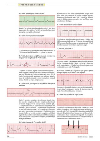 Ecg pour les nuls partie 2 | PDF