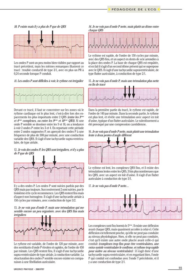 Ecg pour les nuls partie 2