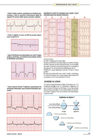 P É D A G O G I E D E L’ E C G

• Onde T ample, pointue, symétrique sur ischémie myocardique ; noter le caractère franchement rigide du
segment ST surtout visible après le premier complexe

Différents aspects possibles de l’onde T sont
exposés dans les tracés suivants :

1

2

3

4

5

6

• Onde T négative (à noter un BAV du premier degré),
tracé normal en V1

• Aspect d’ischémie sous-épicardique avec onde T ample,
pointue, symétrique, sur ischémie myocardique (rythme
en fibrillation auriculaire)

1. Tracé normal
2. Onde T s’aplatissant en précordial
3. Aspect d’ischémie sous-épicardique en antérieur étendu
4. Onde T inversée sur bloc de branche droit ; en cas de BBD,
une onde T inversée est normale jusqu’en V3, à surveiller si
elle dépasse V4, est franchement pathologique dès V5
5. BBD avec cupule digitalique associée, et onde T restant
positive
6. Angor per-tachycardie avec onde T ample, symétrique,
et courant de lésion sous endocardique apico-latéral (ST
ascendant en V2-V3, sous décalé de V4 à V6)

Ischémie ou lésion
• Autres aspects d’ondes T négatives, asymétriques sur
surcharge ventriculaire, sans caractère ischémique myocytaire

Un moyen mnémotechnique simple est de placer un « O »
symbole de la lésiOn, et un « X » symbole de l’ « iXhémie » de
part et d’autre de la ligne iso-électrique, le sous-épicardique
étant au dessus de la ligne, le sous-endocardique en dessous.
Une onde T négative sera une ischémie sous-épicardique,
et ainsi de suite.

Ischémie ou lésion ?

URGENCE PRATIQUE - 2008 No90

55

 