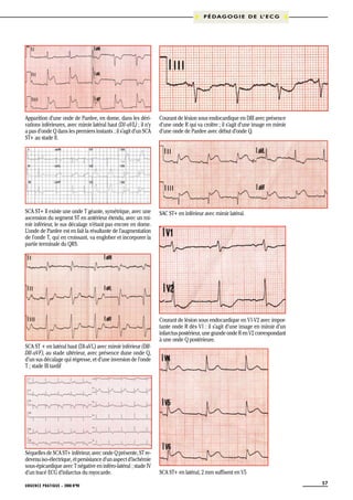 P É D A G O G I E D E L’ E C G

Apparition d’une onde de Pardee, en dome, dans les dérivations inférieures, avec miroir latéral haut (D1-aVL) ; il n’y
a pas d’onde Q dans les premiers instants ; il s’agit d’un SCA
ST+ au stade II.

Courant de lésion sous endocardique en DIII avec présence
d’une onde R qui va croître ; il s’agit d’une image en miroir
d’une onde de Pardee avec début d’onde Q.

SCA ST+ Il existe une onde T géante, symétrique, avec une
ascension du segment ST en antérieur étendu, avec un miroir inférieur, le sus décalage n’étant pas encore en dome.
L’onde de Pardee est en fait la résultante de l’augmentation
de l’onde T, qui en croissant, va englober et incorporer la
partie terminale du QRS.

SAC ST+ en inférieur avec miroir latéral.

SCA ST + en latéral haut (DI-aVL) avec miroir inférieur (DIIDII-aVF), au stade ultérieur, avec présence dune onde Q,
d’un sus décalage qui régresse, et d’une inversion de l’onde
T ; stade III tardif

Séquelles de SCA ST+ inférieur, avec onde Q présente, ST redevenu iso-électrique, et persistance d’un aspect d’ischémie
sous-épicardique avec T négative en inféro-latéral ; stade IV
d’un tracé ECG d’infarctus du myocarde.
URGENCE PRATIQUE - 2008 No90

Courant de lésion sous endocardique en V1-V2 avec importante onde R dès V1 : il s’agit d’une image en miroir d’un
infarctus postérieur, une grande onde R en V2 correspondant
à une onde Q postérieure.

SCA ST+ en latéral, 2 mm suffisent en V5
57

 