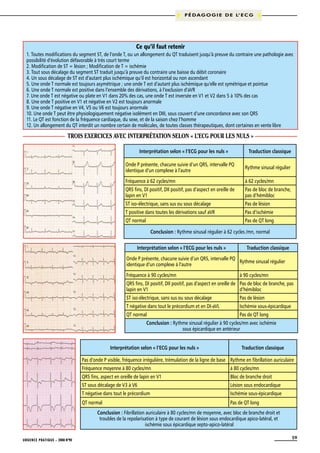 P É D A G O G I E D E L’ E C G

Ce qu’il faut retenir
1. Toutes modifications du segment ST, de l’onde T, ou un allongement du QT traduisent jusqu’à preuve du contraire une pathologie avec
possibilité d’évolution défavorable à très court terme
2. Modification de ST = lésion ; Modification de T = ischémie
3. Tout sous décalage du segment ST traduit jusqu’à preuve du contraire une baisse du débit coronaire
4. Un sous décalage de ST est d’autant plus ischémique qu’il est horizontal ou non ascendant
5. Une onde T normale est toujours asymétrique ; une onde T est d’autant plus ischémique qu’elle est symétrique et pointue
6. Une onde T normale est positive dans l’ensemble des dérivations, à l’exclusion d’aVR
7. Une onde T est négative ou plate en V1 dans 20% des cas, une onde T est inversée en V1 et V2 dans 5 à 10% des cas
8. Une onde T positive en V1 et négative en V2 est toujours anormale
9. Une onde T négative en V4, V5 ou V6 est toujours anormale
10. Une onde T peut être physiologiquement négative isolément en DIII, sous couvert d’une concordance avec son QRS
11. Le QT est fonction de la fréquence cardiaque, du sexe, et de la saison chez l’homme
12. Un allongement du QT interdit un nombre certain de molécules, de toutes classes thérapeutiques, dont certaines en vente libre

Trois exercices avec interprétation selon « L’ECG pour les nuls »
Interprétation selon « l’ECG pour les nuls »

Traduction classique

Onde P présente, chacune suivie d’un QRS, intervalle PQ
identique d’un complexe à l’autre

Rythme sinusal régulier

Fréquence à 62 cycles/mn

à 62 cycles/mn

QRS fins, DI positif, DII positif, pas d’aspect en oreille de
lapin en V1

Pas de bloc de branche,
pas d’hémibloc

ST iso-électrique, sans sus ou sous décalage

Pas de lésion

T positive dans toutes les dérivations sauf aVR

Pas d’ischémie

QT normal

Pas de QT long
Conclusion : Rythme sinusal régulier à 62 cycles /mn, normal

Interprétation selon « l’ECG pour les nuls »

Traduction classique

Onde P présente, chacune suivie d’un QRS, intervalle PQ
Rythme sinusal régulier
identique d’un complexe à l’autre
Fréquence à 90 cycles/mn

à 90 cycles/mn

QRS fins, DI positif, DII positif, pas d’aspect en oreille de Pas de bloc de branche, pas
lapin en V1
d’hémibloc
ST iso-électrique, sans sus ou sous décalage

Pas de lésion

T négative dans tout le précordium et en DI-aVL

Ischémie sous-épicardique

QT normal

Pas de QT long

Conclusion : Rythme sinusal régulier à 90 cycles/mn avec ischémie
sous épicardique en antérieur
Interprétation selon « l’ECG pour les nuls »

Traduction classique

Pas d’onde P visible, fréquence irrégulière, trémulation de la ligne de base Rythme en fibrillation auriculaire
Fréquence moyenne à 80 cycles/mn

à 80 cycles/mn

QRS fins, aspect en oreille de lapin en V1

Bloc de branche droit

ST sous décalage de V3 à V6

Lésion sous endocardique

T négative dans tout le précordium

Ischémie sous-épicardique

QT normal

Pas de QT long

Conclusion : Fibrillation auriculaire à 80 cycles/mn de moyenne, avec bloc de branche droit et
troubles de la repolarisation à type de courant de lésion sous endocardique apico-latéral, et
ischémie sous épicardique septo-apico-latéral
URGENCE PRATIQUE - 2008 No90

59

 