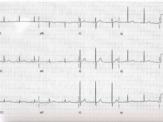 ECG PPI, ASD | PPT