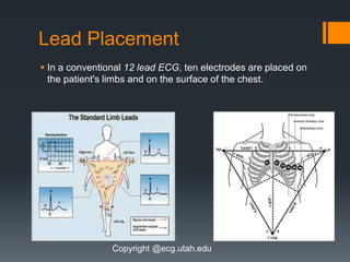 Lead Placement
 In a conventional 12 lead ECG, ten electrodes are placed on
the patient's limbs and on the surface of the chest.
Copyright @ecg.utah.edu
 