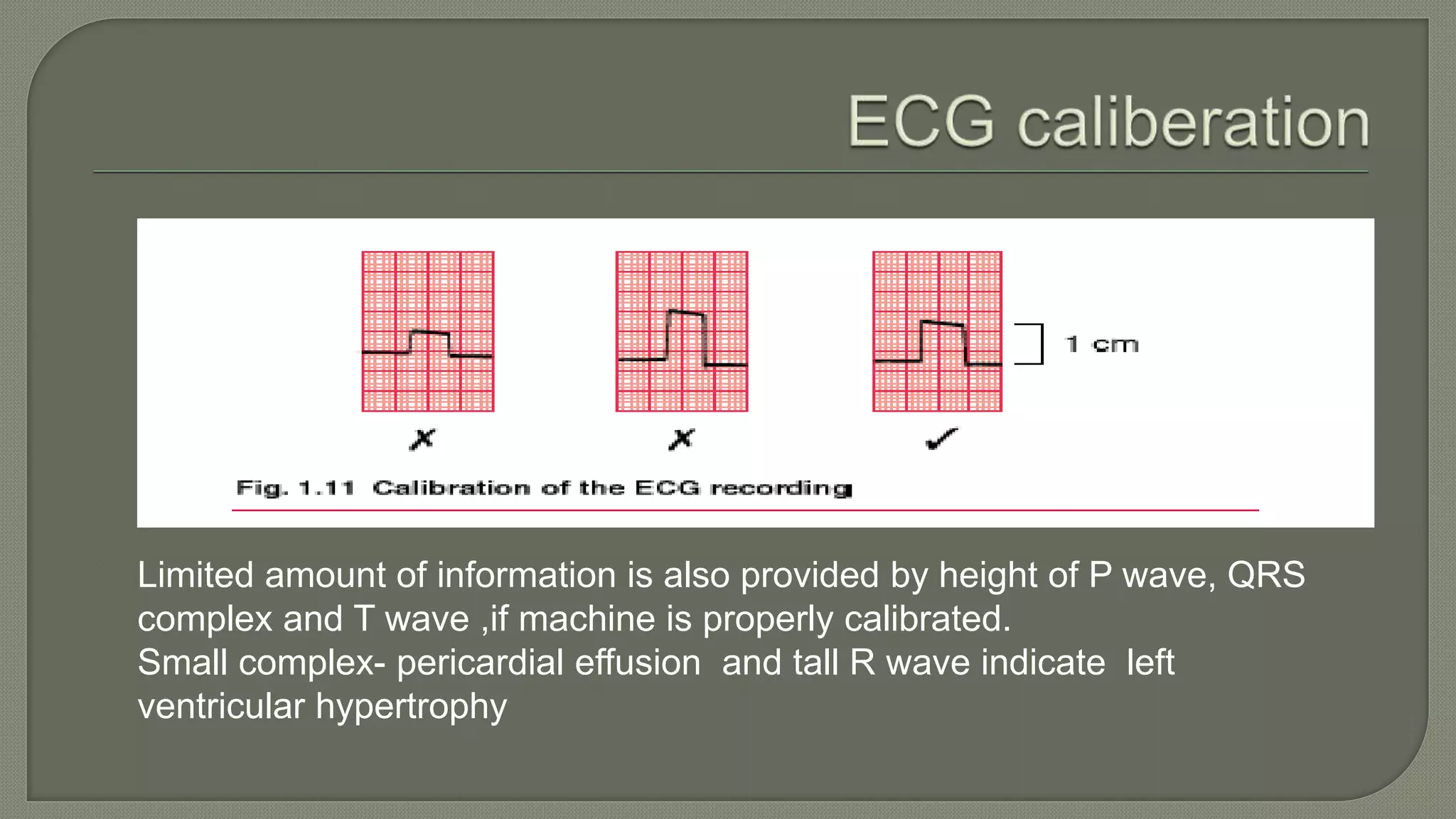 Limited amount of information is also provided by height of P wave, QRS
complex and T wave ,if machine is properly calibrated.
Small complex- pericardial effusion and tall R wave indicate left
ventricular hypertrophy
 