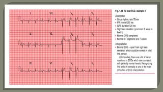 Ecg ppt