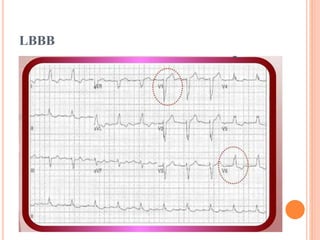 LBBB
 