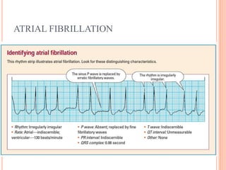 ATRIAL FIBRILLATION
 