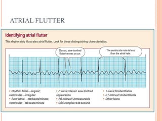 ATRIAL FLUTTER
 