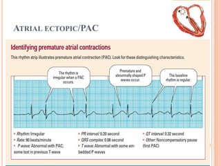 ATRIAL ECTOPIC/PAC
 