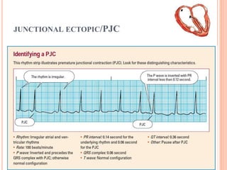 JUNCTIONAL ECTOPIC/PJC
 