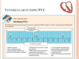 VENTRICULAR ECTOPIC/PVC
 