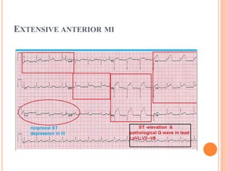 EXTENSIVE ANTERIOR MI
 