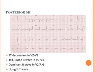 POSTERIOR MI
 ST depression in V2-V3
 Tall, Broad R wave in V2-V3
 Dominant R wave in V2(R>S)
 Upright T wave
 