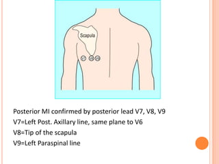 Posterior MI confirmed by posterior lead V7, V8, V9
V7=Left Post. Axillary line, same plane to V6
V8=Tip of the scapula
V9=Left Paraspinal line
 