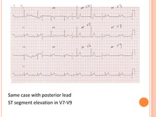 Same case with posterior lead
ST segment elevation in V7-V9
 