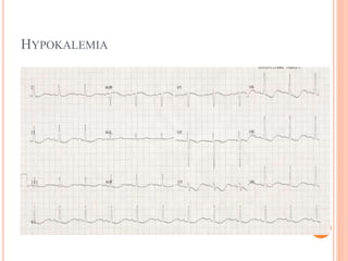 HYPOKALEMIA
 