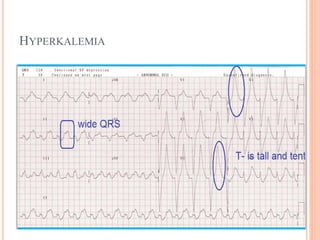 HYPERKALEMIA
 