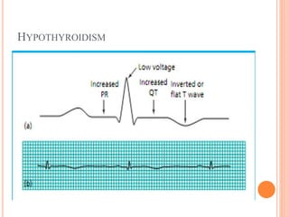 HYPOTHYROIDISM
 