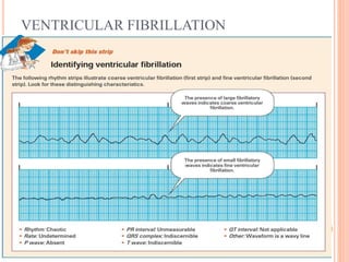 VENTRICULAR FIBRILLATION
 