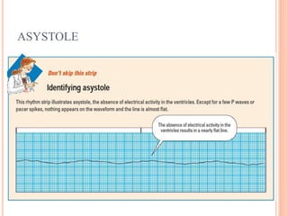 ASYSTOLE
 