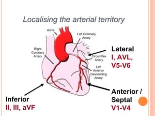 Localising the arterial territory
Inferior
II, III, aVF
Lateral
I, AVL,
V5-V6
Anterior /
Septal
V1-V4
 