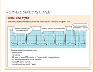 NORMAL SINUS RHYTHM
 Originates in the sinus node
 Rate between 60 and 100 beats per min
 Monomorphic P waves
 Normal relationship between P and QRS
 Some sinus arrhythmia is normal
 