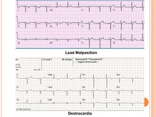 Lead Malposition
Dextrocardia
 