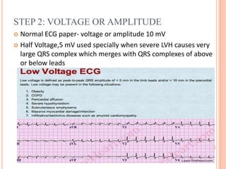 STEP 2: VOLTAGE OR AMPLITUDE
 Normal ECG paper- voltage or amplitude 10 mV
 Half Voltage,5 mV used specially when severe LVH causes very
large QRS complex which merges with QRS complexes of above
or below leads
 