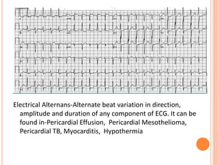 Electrical Alternans-Alternate beat variation in direction,
amplitude and duration of any component of ECG. It can be
found in-Pericardial Effusion, Pericardial Mesothelioma,
Pericardial TB, Myocarditis, Hypothermia
 