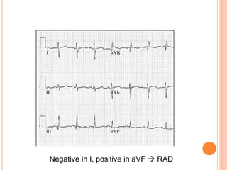 Negative in I, positive in aVF  RAD
 