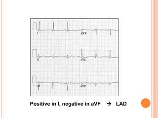 Positive in I, negative in aVF  LAD
 