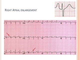 RIGHT ATRIAL ENLARGEMENT
 