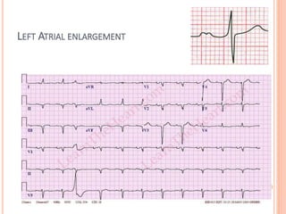 LEFT ATRIAL ENLARGEMENT
 